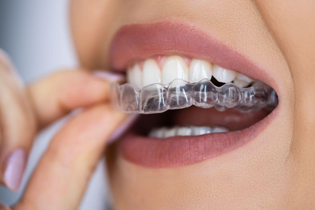 5 Tips to Get the Most out of Clear Aligners