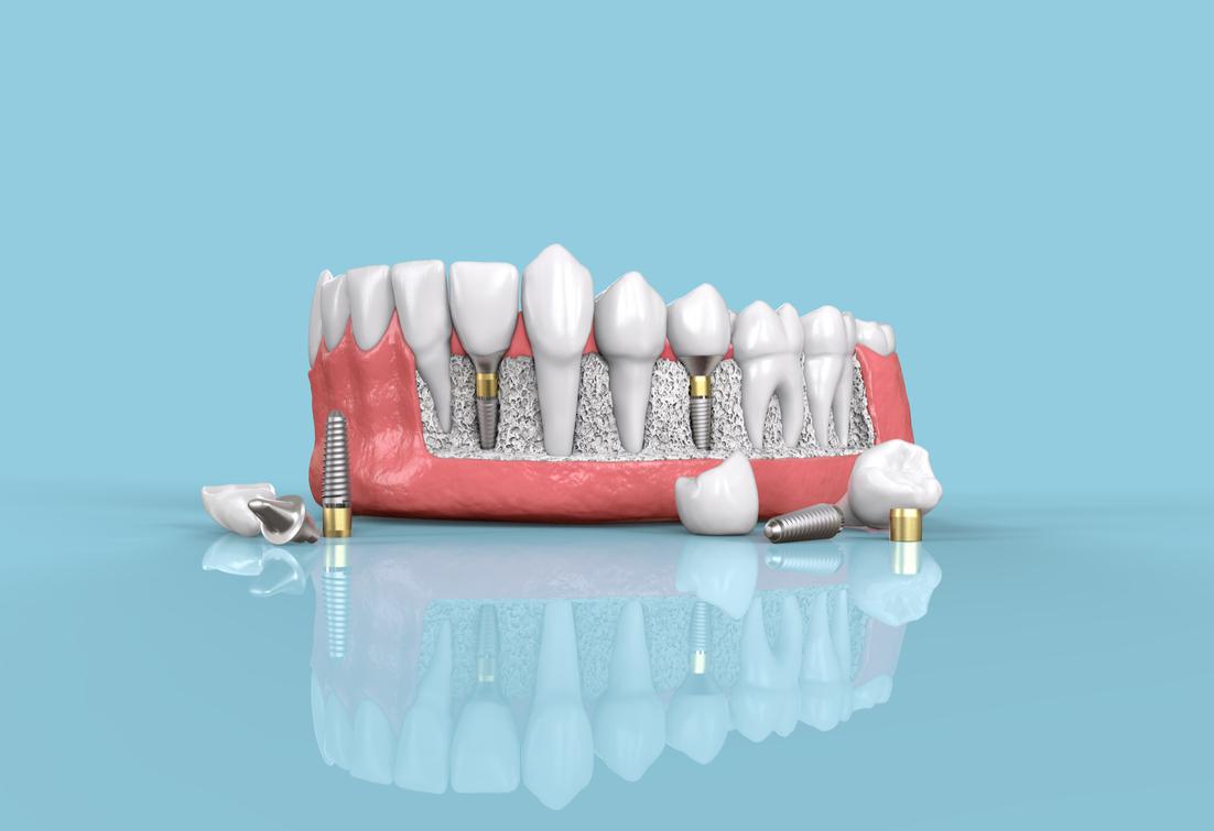 Dental Implants Philadelphia, PA