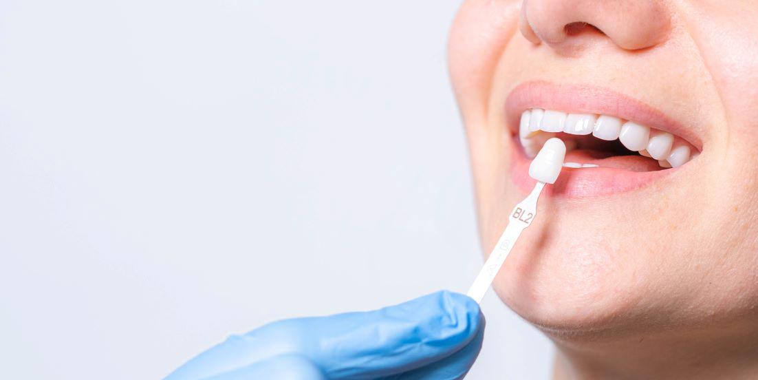 How To Care for Porcelain Veneers